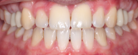 After treatment for Dental Implants in Hornchurch