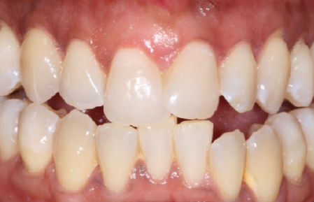 After treatment for Gingival lesions in Hornchurch