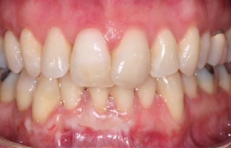 After treatment for Localised gingival recession in Hornchurch