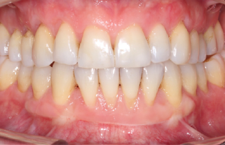 After treatment for Multiple gingival recession in Hornchurch