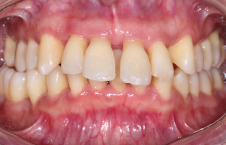 After treatment for Severe Periodontitis in Hornchurch