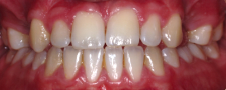 Before treatment for Dental Implants in Hornchurch