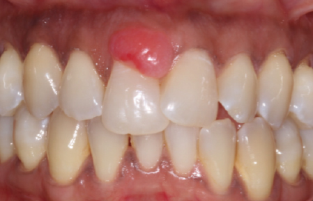 Before treatment for Gingival lesions in Hornchurch