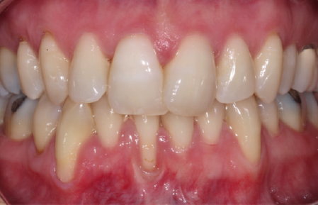 Before treatment for Localised gingival recession in Hornchurch