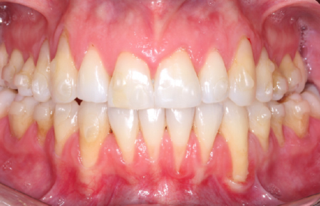 Before treatment for Multiple gingival recession in Hornchurch