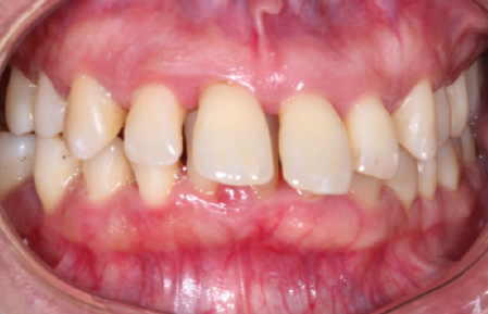 Before treatment for Severe Periodontitis in Hornchurch